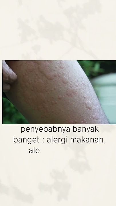 biduran, bentol- bentol. kenapa ya