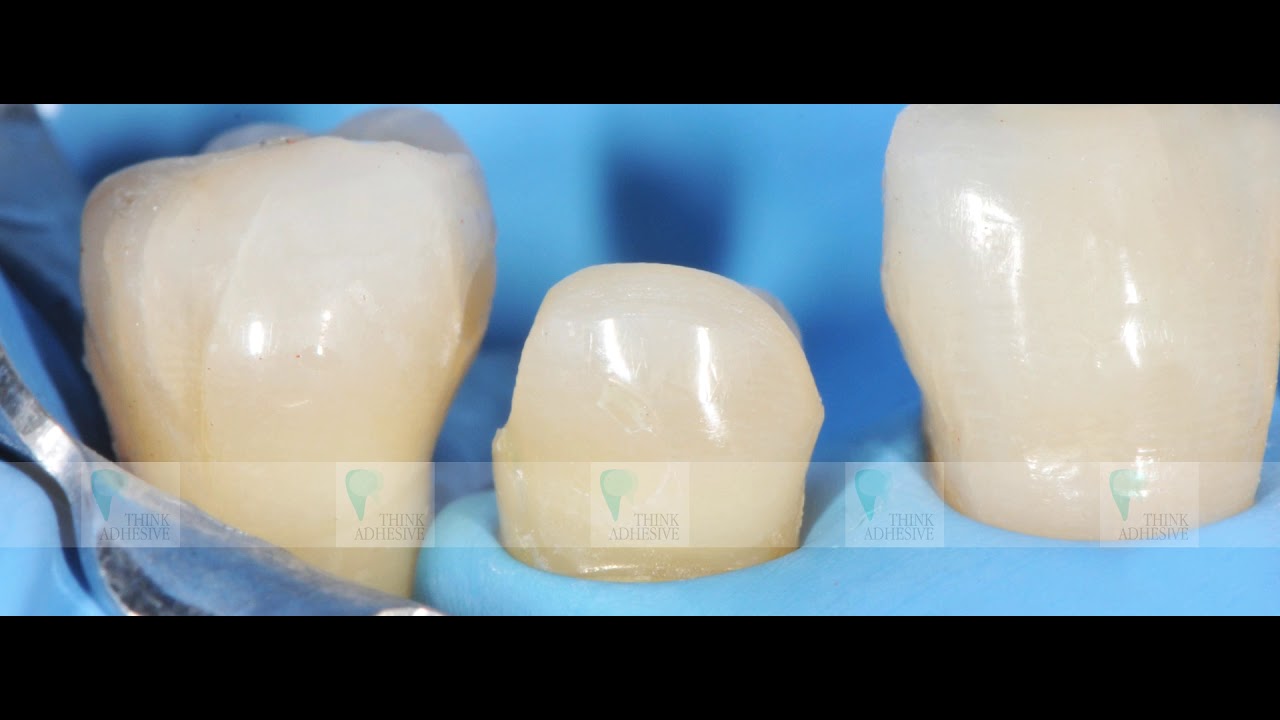 THINK ADHESIVE PILLS - ADATTAMENTO DIGITALE DI PROTESI FISSA SOTTO SCHELETRATO