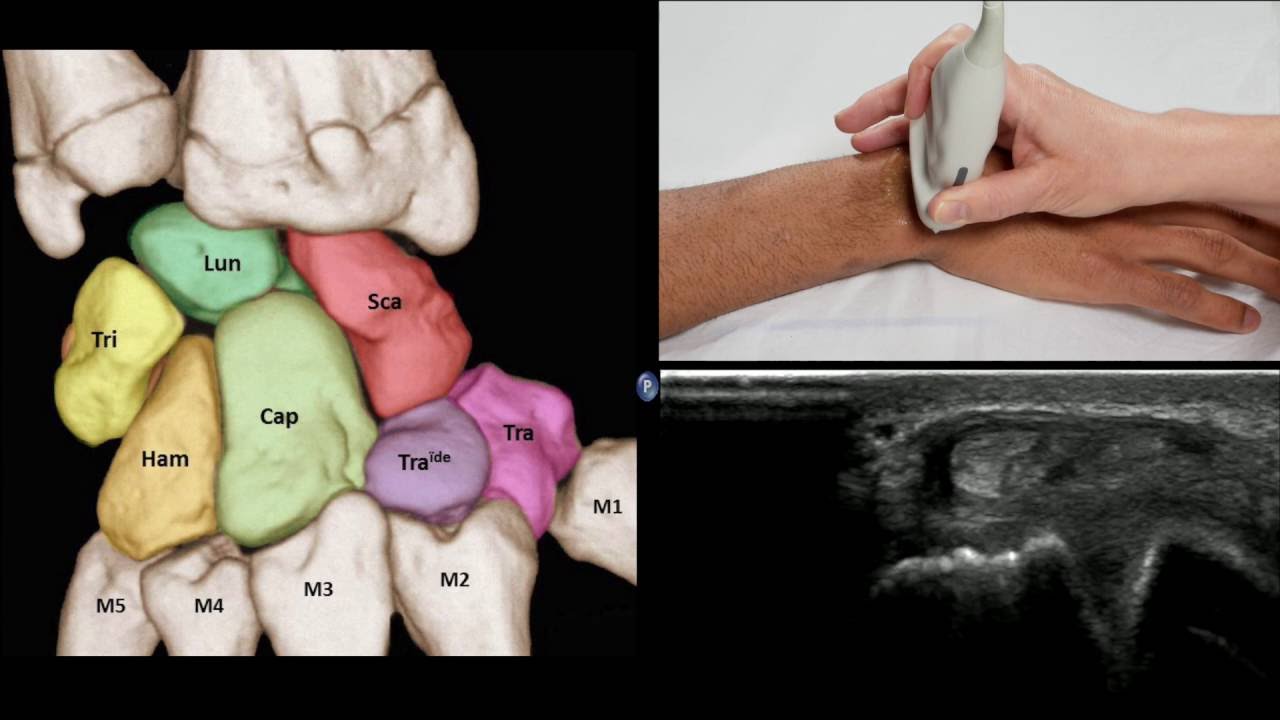 Échographie du poignet et des doigts
