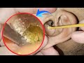 Horror: Clean dry earwax in the ear canal, infected ear canal | ASMR | EP 218