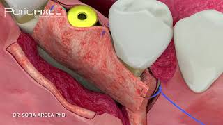Soft Tissue Managment at the time of Implant Placement screenshot 1