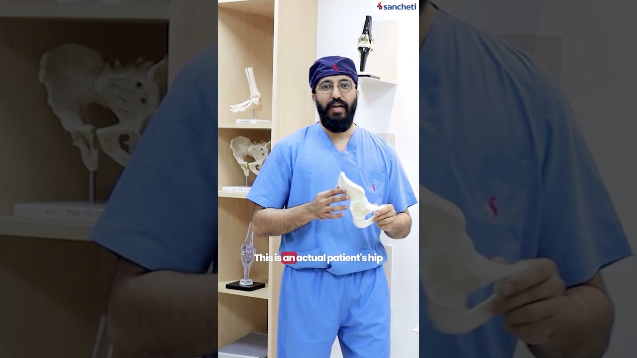 Advanced Surgery: 3D Printing in Orthopedics Explained | What You Must Know | Dr. Sahil Sanghavi