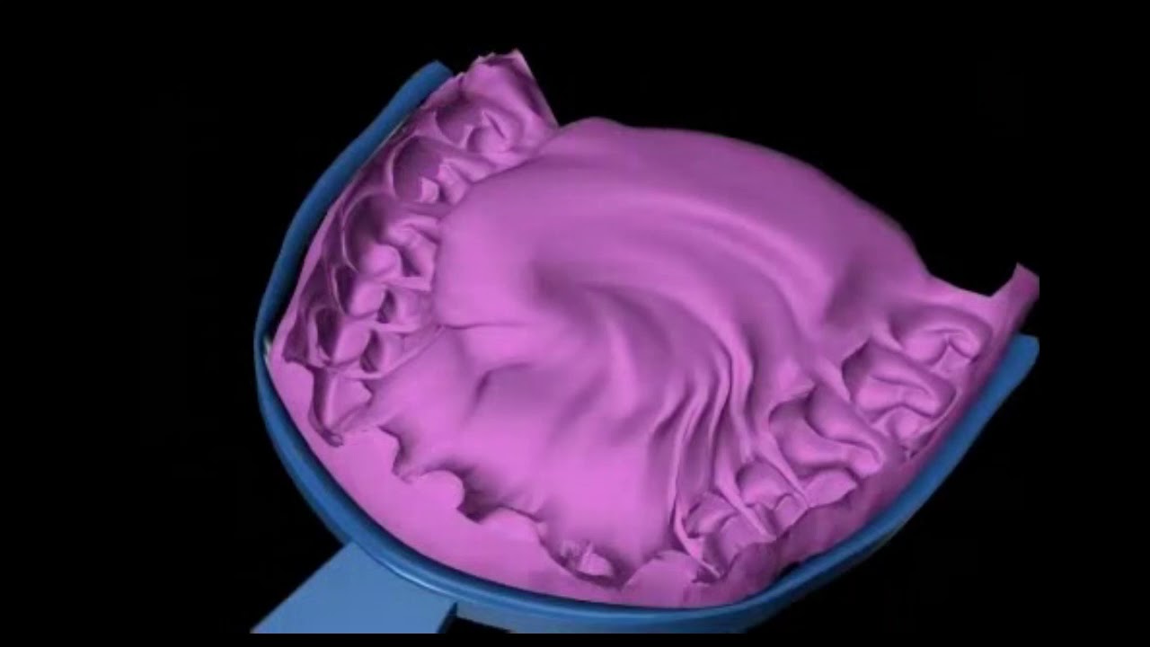 Greseala la amprentare dentara