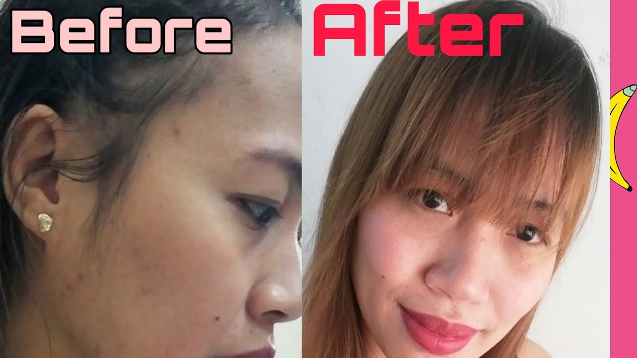 Paano gamutin ang lumalalang pimples sa Saudi Arabia ? How to treat