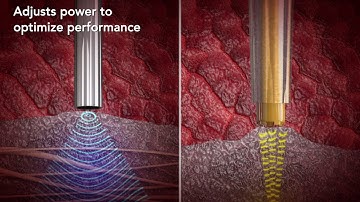 CUSA Clarity Adaptive Power