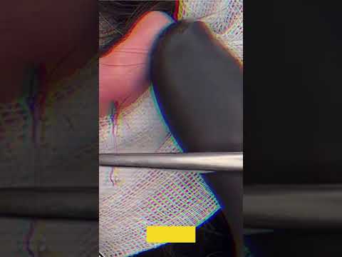 Ingrown Hair Super Zoom #내성 모발 #ingrownhair #내성발톱  #Shorts