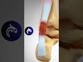 Achilles Tendonitis And Rupture 3D Animation Achilles Foot Feet