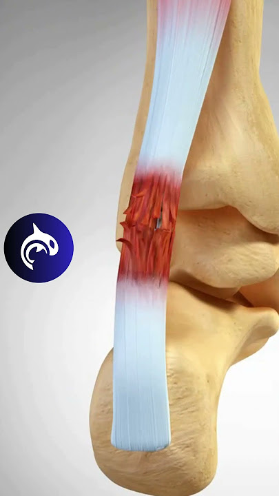 Achilles Tendonitis and Rupture - 3D Animation #achilles #foot #feet