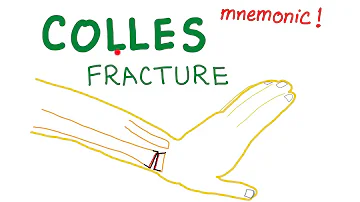 Colles Fracture Mnemonic