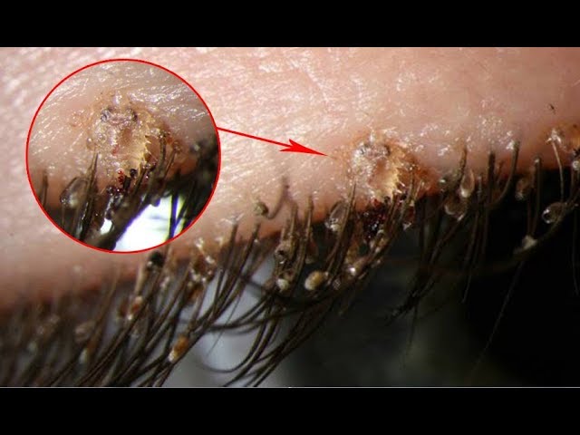 Pubic lice Symptoms – Causes Treatment Signs and Symptoms of Pubic lice and  Pubic Crab - YouTube