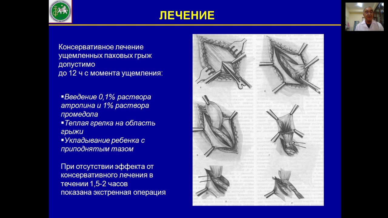 Паховая грыжа методы лечения