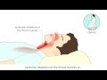 Obstructive Sleep Apnea Syndrome  (OSAS) - Causes and treatment