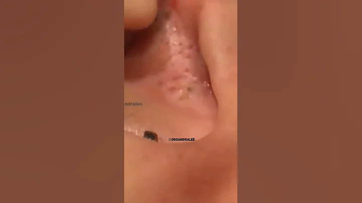 Ear Blackhead #asmrsounds | Dr. Pimple Popper #shorts #pimples #oddlysatisfying