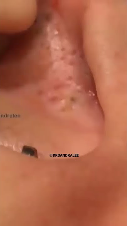 Ear Blackhead #asmrsounds | Dr. Pimple Popper #shorts #pimples #oddlysatisfying