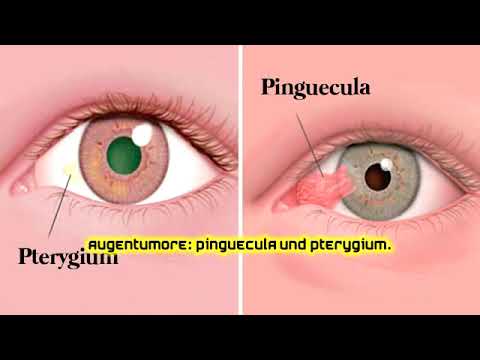 Augentumore: Pinguecula und Pterygium