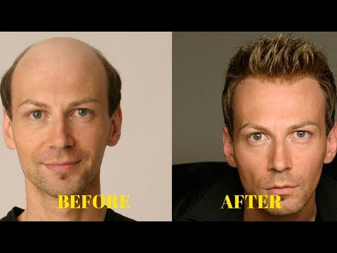 hair regrowth for men naturally