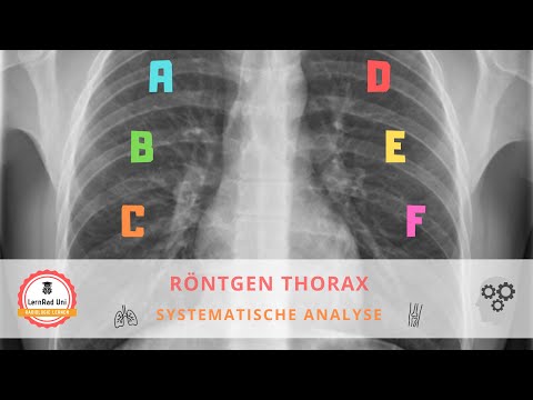 Video: Würde ein Wirbelsäulentumor auf dem Röntgenbild erscheinen?