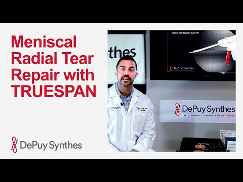 All-Inside Radial Meniscal Tear Repair with TRUESPAN Meniscal Repair ...