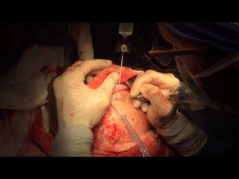 Video: Chirurgia Di Riduzione Della Fronte: Procedura, Costo, Altre Opzioni
