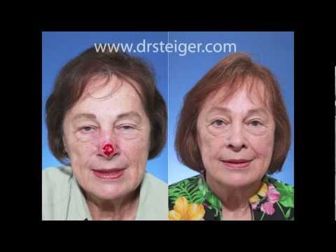Video thumbnail: Nasal Reconstruction with a Forehead Flap in South Florida — Dr. Jacob D. Steiger MD