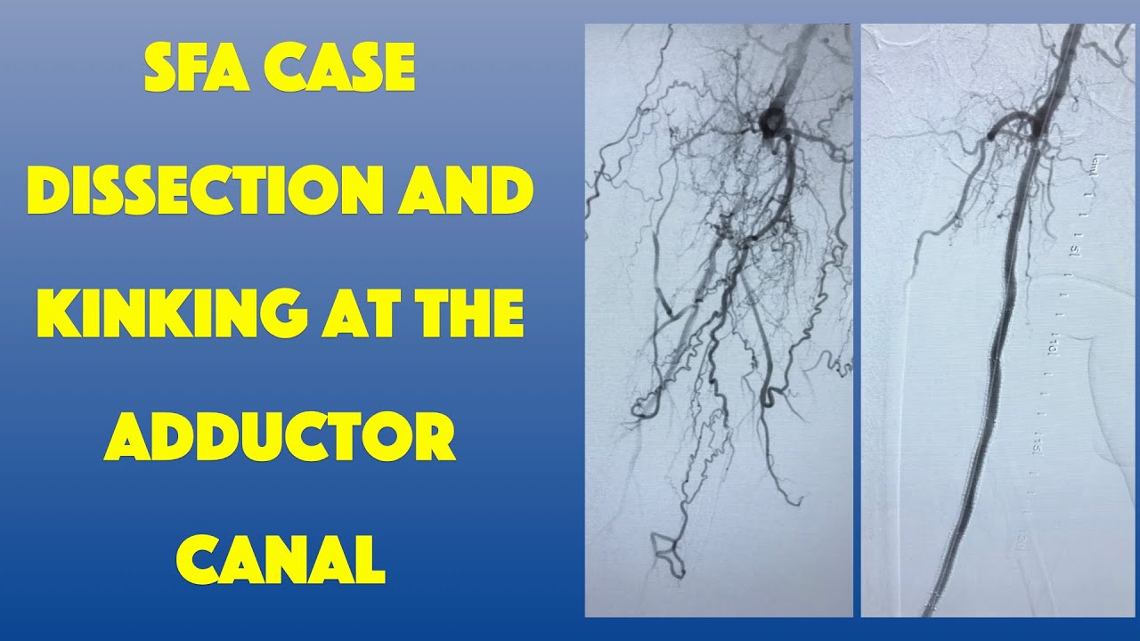 SFA Case: Dealing with the Biomechanics of the FemPop Segment