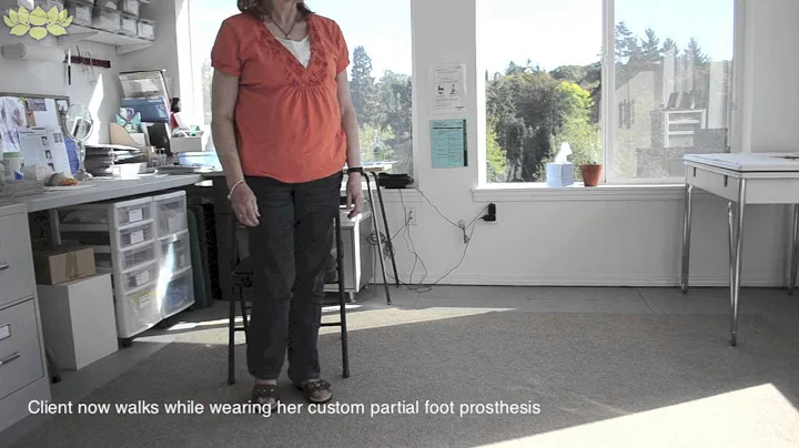Walking with and without partial foot prosthesis   ~   Tacoma, WA    ~  Anaplastology Clinic