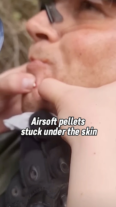 Airsoft pellets stuck under the skin #airsoftshorts #airsoft #army #shorts #shortsvideo