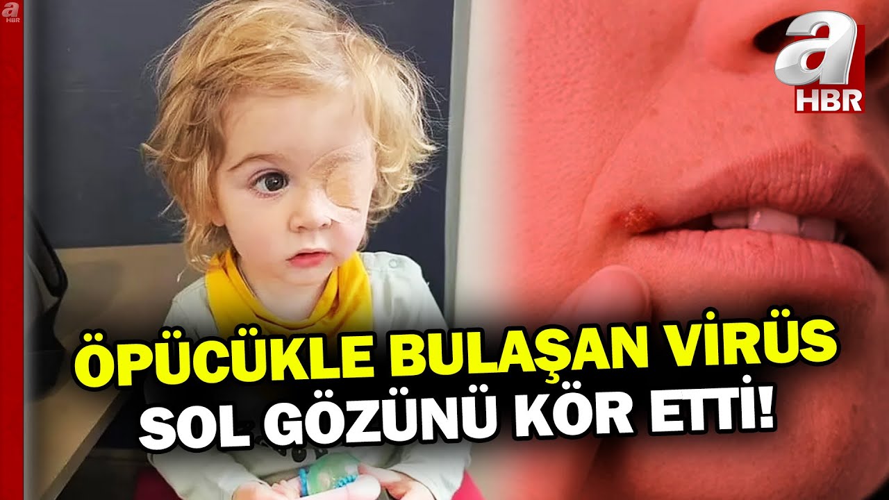Küçük çocuk bir öpücükle gözünü kaybetti! 