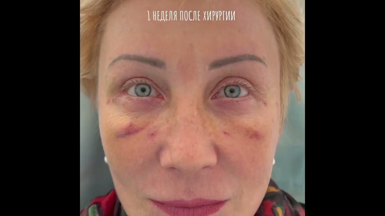 Эндоскопический лобно височный лифтинг, нижняя блефаропластика, односторонняя верхняя блефаропластик