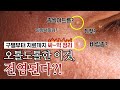 오톨도톨한 이것, 좁쌀여드름이 아니었다..?😨 (+🔥OOO는 작아도 바로 없애야 합니다🔥) - [언니네피부과]