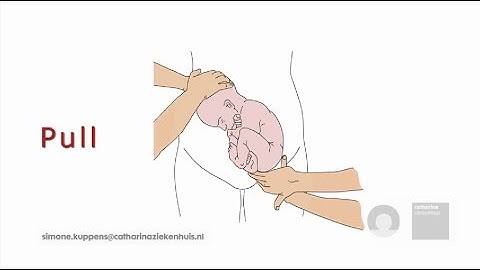 External Cephalic Version (ECV) technique in theory (animation)