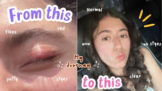 How I got RID of my styes/chalazions after years | Incredible Remedies, Pictures, Journey and Places