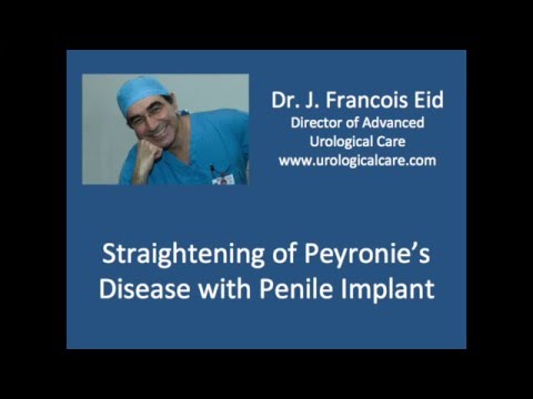 Straightening of Peyronie's Disease with Penile Implant