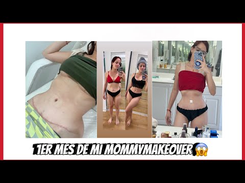 Mi primer mes de mommymakeover #tummytucksurgery #mastopexia #abdominoplastia #miami