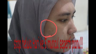 STOP MENGGUNAKAN HELWA BEAUTY CARE TIMBUL SEPERTI PANU!!