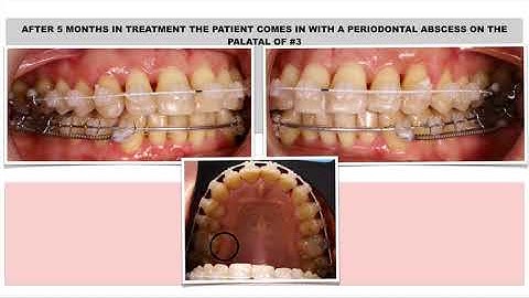 Webinar T scan and orthodontics shortcut