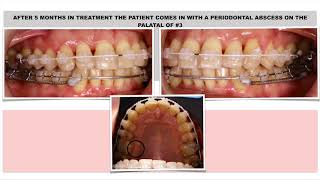 Webinar T scan and orthodontics shortcut