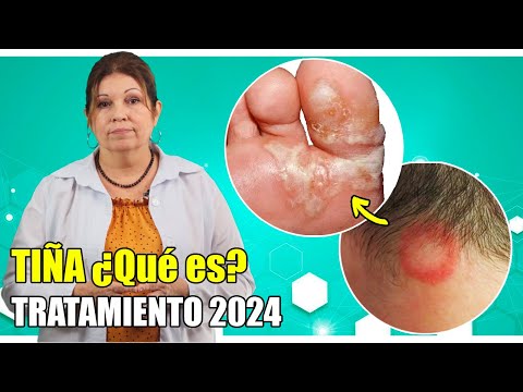 🛑 TIÑA del pie ¿Qué es? 😳 Tratamiento actualizado 👈