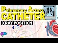 ICU Advantage: Understanding Pulmonary Artery Catheters