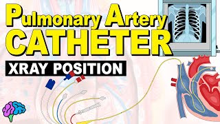 Reading X-rays for Pulmonary Artery (PA) Catheter Positioning