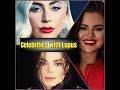 Famous Celebrities With Lupus.