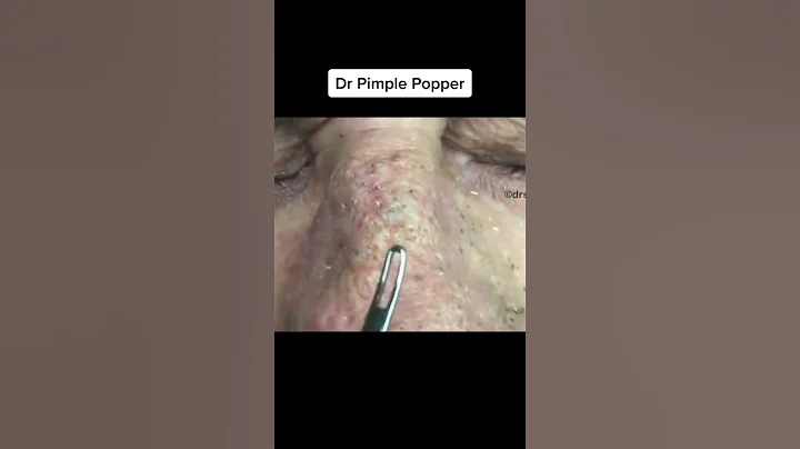 Nose Blackheads To Start Your Weekend #shorts