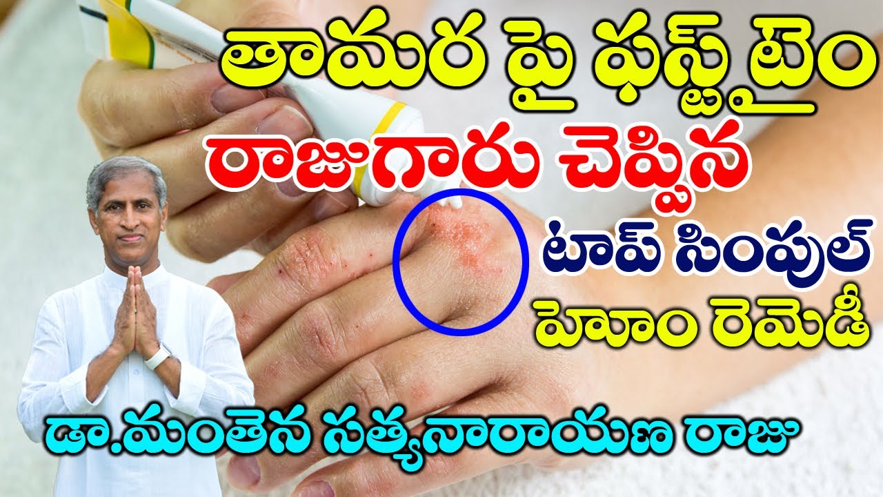 Eczema | తామర పై ఫస్ట్ టైం రాజు గారు చెప్పిన టాప్ సింపుల్ రెమెడీ! | Dr Manthena Satyanarayana Raju