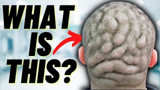 DOCTOR EXPLAINS CUTIS VERTICIS GYRATA | A condition which causes folds in the scalp (plus PHOTOS)