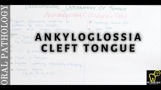 Ankyloglossia & Cleft tongue | Developmental Disturbances Of Tongue Part-2 |