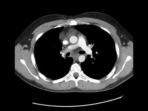 Mediastinite fibrosante