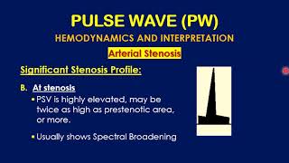 Doppler Waveform   C