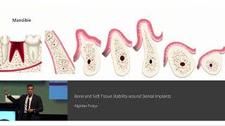 Bone and Soft Tissue Stability around Dental Implants | Algirdas Puisys screenshot 5