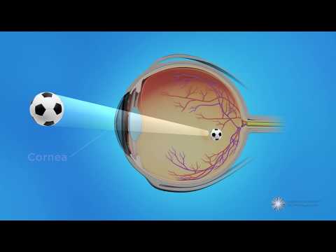 Video: Wat is eksenterasie van die oog?