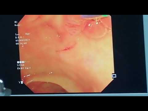 ERCP How to do selective  CBD canulation